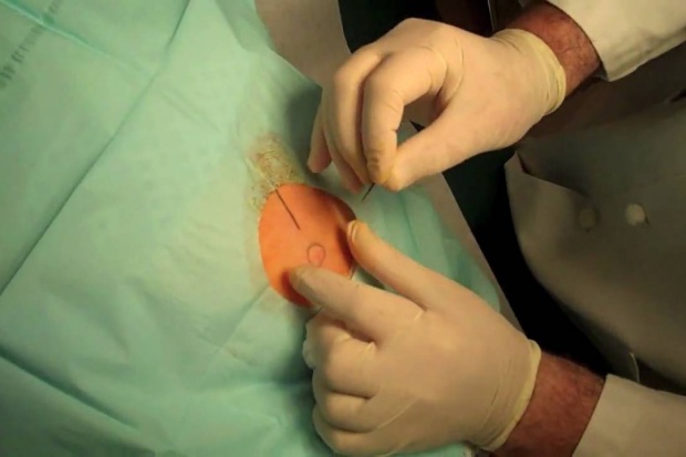 Вшивание Эспераль в Краснодаре